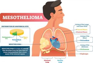Causes and symptoms of mesothelioma cancer